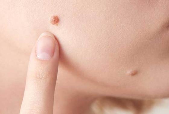 Best Mole Removal Pens