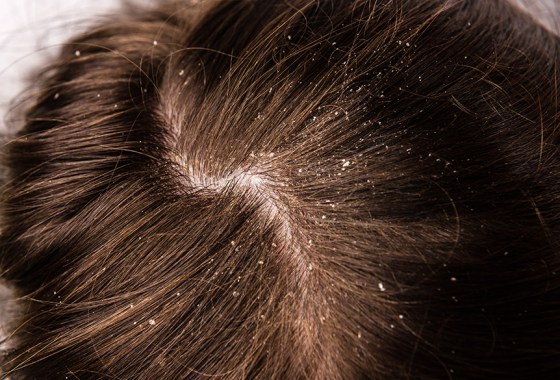 Dandruff vs. dry scalp: Differences and best treatments